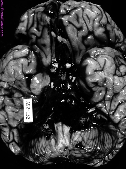 Subarachnoid hemorrhage, base of brain